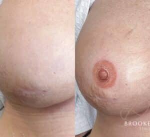 Breast Reconstruction 3D Nipple Tattoo for breast cancer survivors